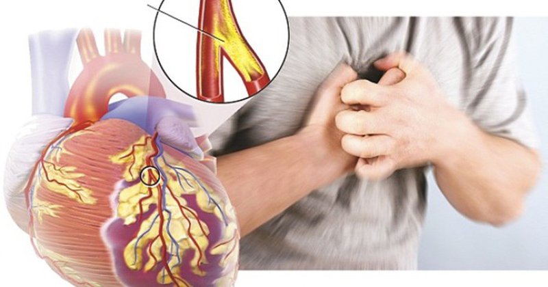 Cơn đau thắt ngực điển hình của bệnh mạch vành